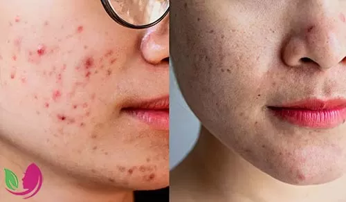 آیا جوش صورت با اسکار آکنه متفاوت است؟