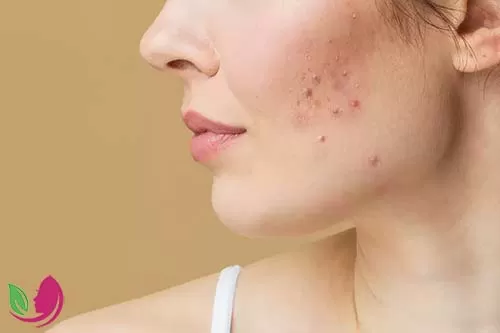 اسکار آکنه چیست؟ علت ایجاد اسکار و انواع آن