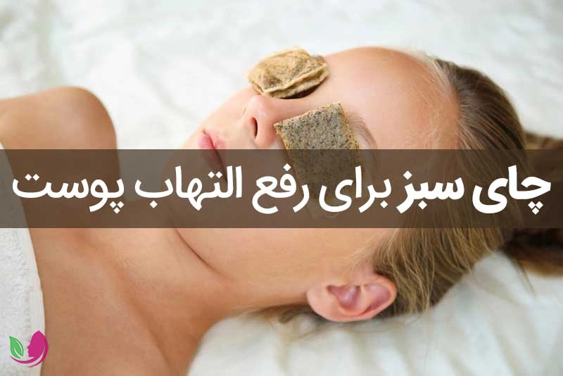 چای سبز برای کاهش التهابات پوستی