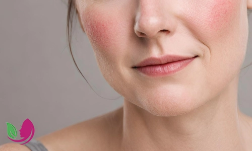 روش‌های خانگی کاهش قرمزی و تورم پوست + روش استفاده