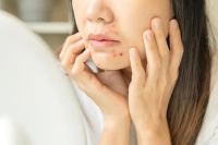 چطور از ایجاد جوش صورت جلوگیری کنیم؟